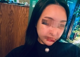 드디어 기다리고 기다린 1퍼센트 광대 한달 차 후기에요