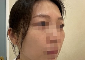 45도 광대 스트레스인 분들 광대축소 수술 강추함니다!