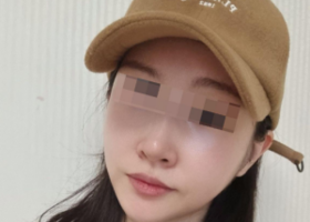 애플존광대+턱끝(미니v+전진술)+풀페이스지방이식 받은지