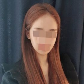 비스포크v라인+퀵광대, 1년 후 광대축소수술